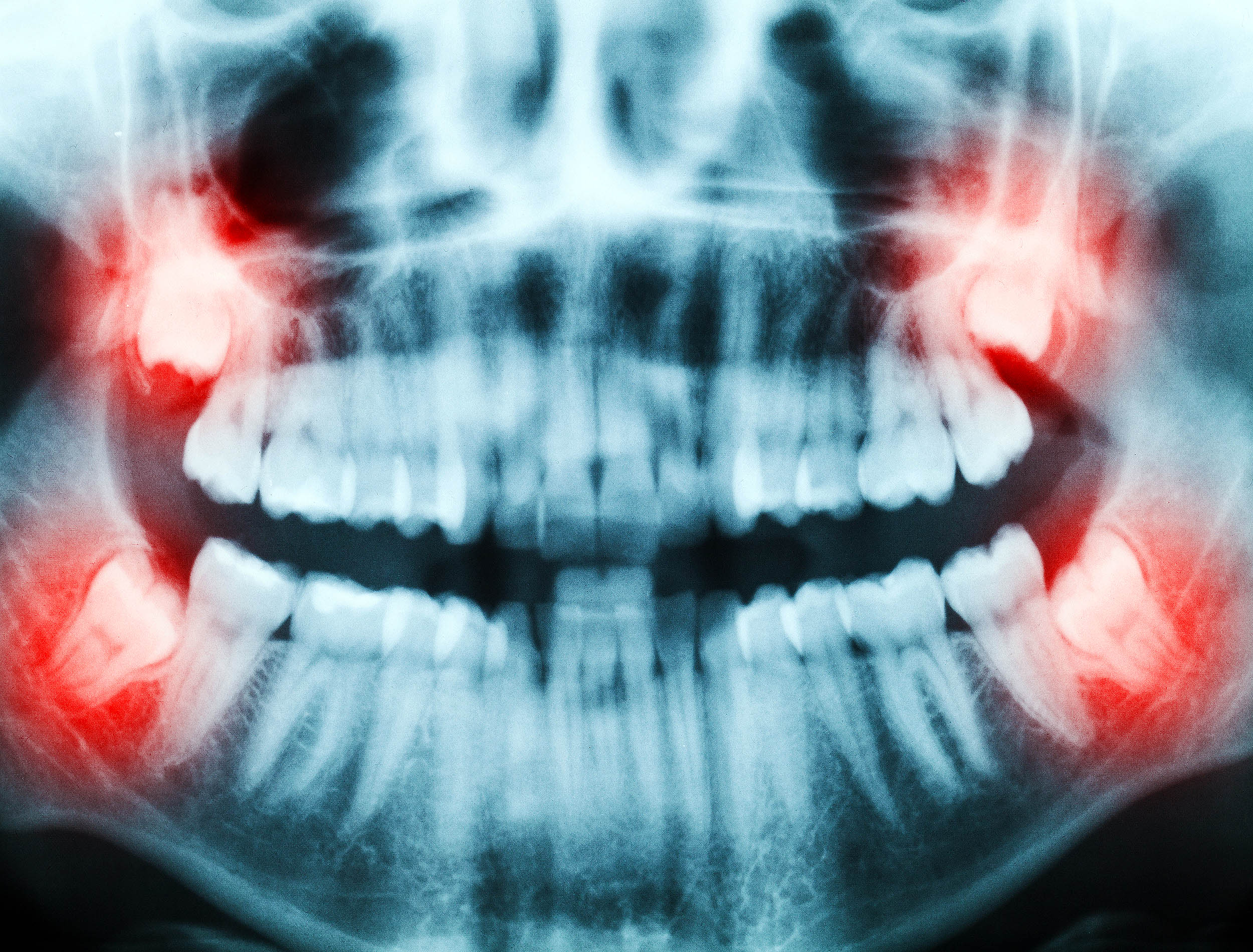 Wisdom Teeth Hold Promise for Regenerative Medicine